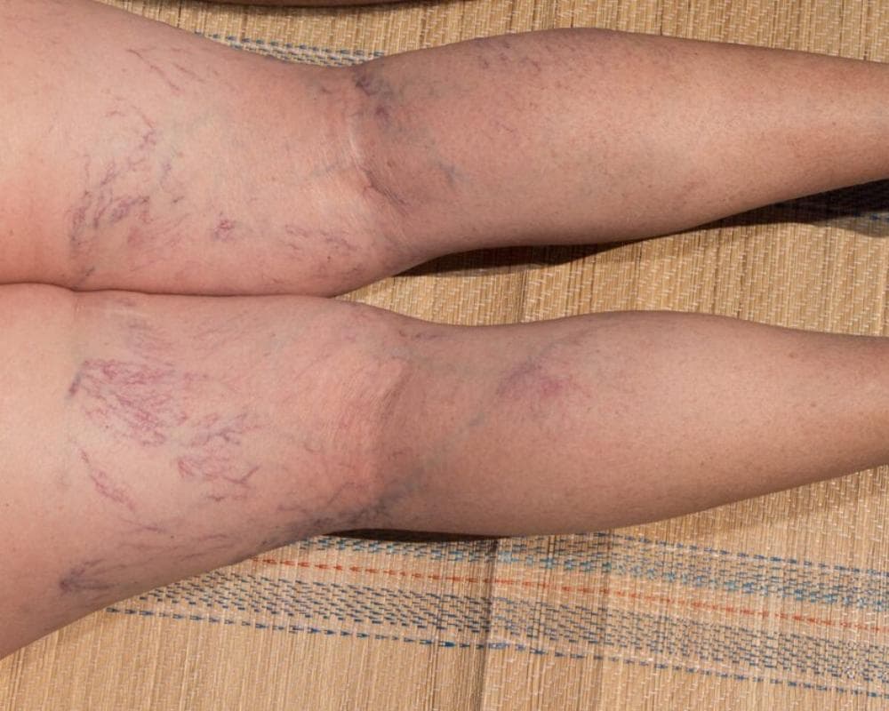 🦵 What Are Varicose Veins? Simple Facts You Should Know